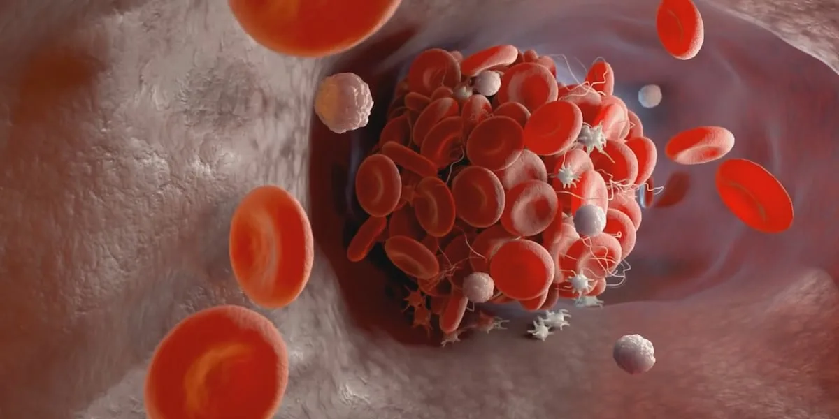 Recognizing the danger of blood clots