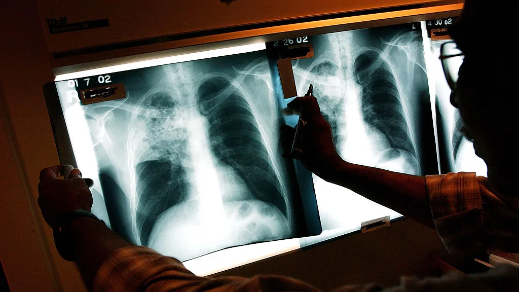 Irving ISD high school investigated for possible tuberculosis exposure