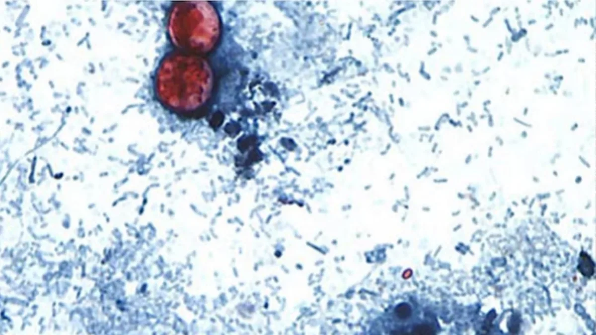 Federal health officials have investigated 5 different clusters of cyclosporiasis cases, FDA says