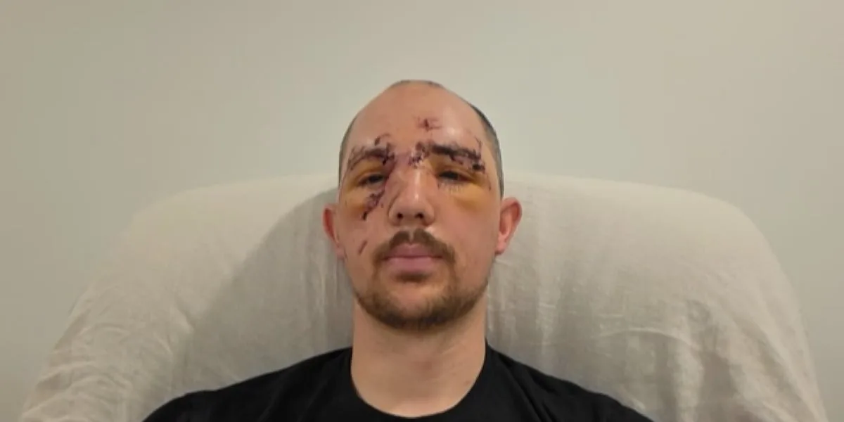 Father bitten in face by bear during hunting trip: 'I could hear all the bones crunching'