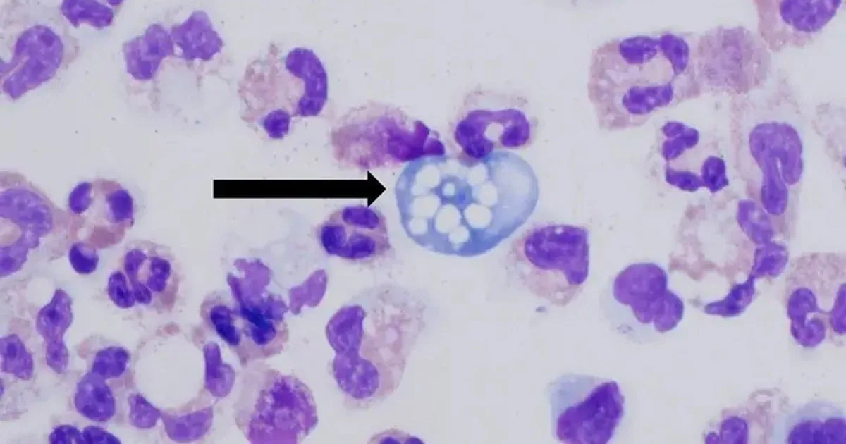 Teen dies from brain-eating amoeba just days after Louisiana child's death