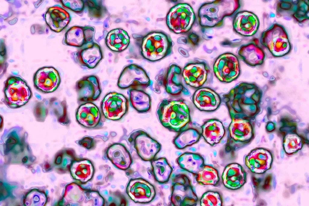 Dallas County confirms measles case with 3 locations for exposure
