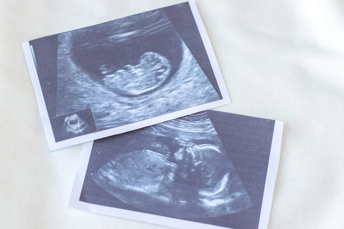 Why abortion opponents are turning their attention to banning surrogacy
