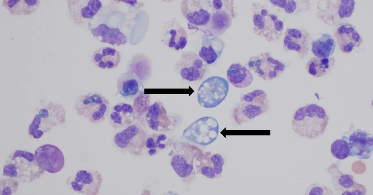Brain-eating amoeba leaves NC teen critically injured