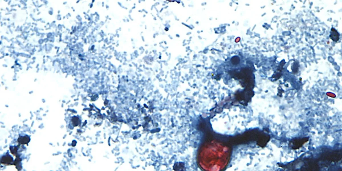Laredo health officials investigating cyclospora cases in Webb County