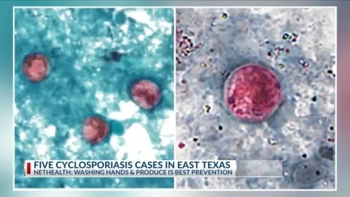 NET HEALTH reports 5 Cyclospora cases in East Texas
